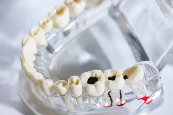 Caries Tooth Model Oral Care Concept Dental Model Present Common — Stock Photo, Image