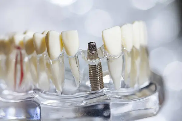 Diş Implantı Titanyum Protez Dişçi Modeli Sığ Dof — Stok fotoğraf