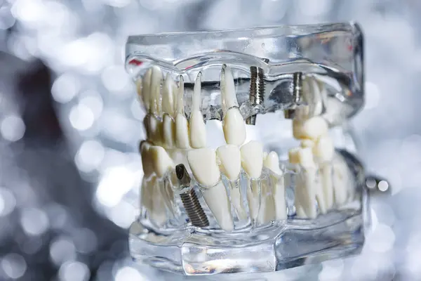 Імплантація Зубів Моделі Титанових Протезів Стоматологів Неглибокий Доф — стокове фото
