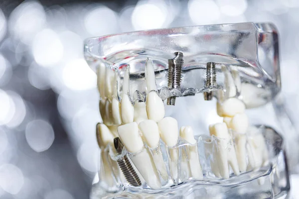 Dental Dente Implante Titânio Prótese Dentistas Modelo Dof Rasa — Fotografia de Stock