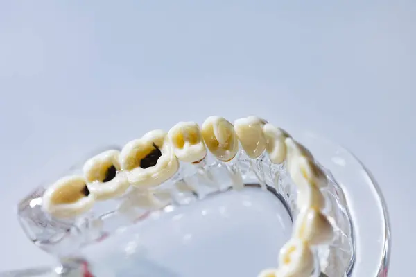 Модель Зуба Карієсу Концепція Догляду Ротовою Порожниною Стоматологічна Модель Представляє — стокове фото