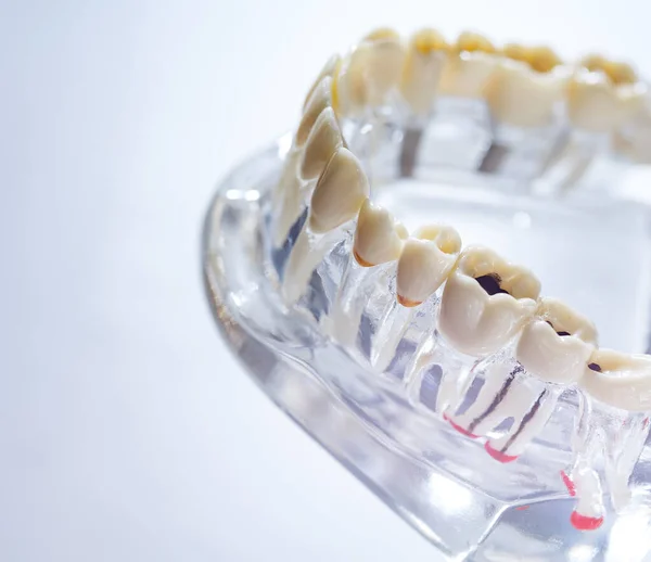 Implante Dental Raíces Dentales Artificiales Mandíbula Conducto Radicular Del Tratamiento — Foto de Stock