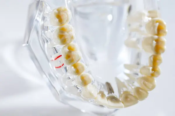 牙科植入物 人工牙根入下巴 牙根治疗管 牙龈疾病 牙科医生牙模型研究 — 图库照片