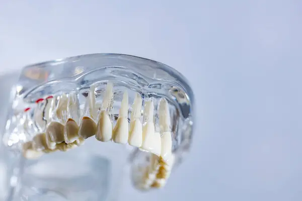 歯科インプラント 顎への人工歯根 歯科治療の根管 歯科医学を研究する歯科医のための歯モデル — ストック写真