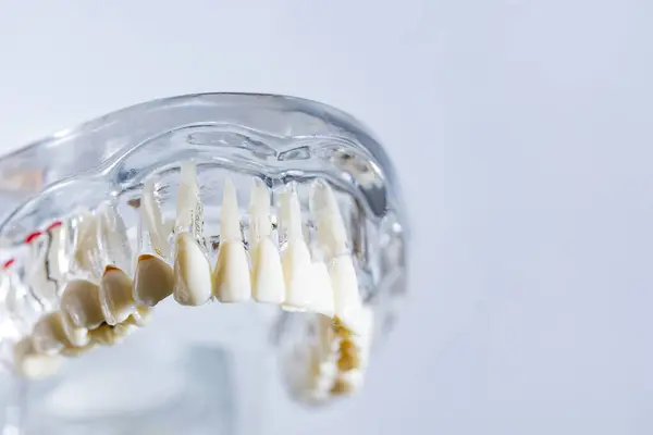 Стоматологический Имплантат Искусственные Корни Зубов Челюсть Корневой Канал Стоматологического Лечения — стоковое фото