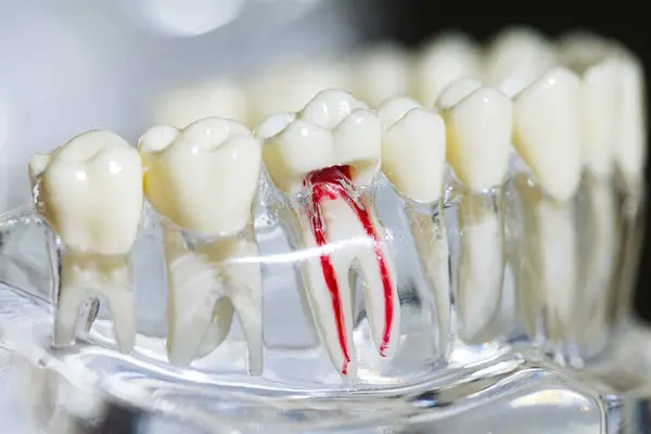 牙科植入物 人工牙根入下巴 牙根治疗管 牙龈疾病 牙科医生牙模型研究 — 图库照片