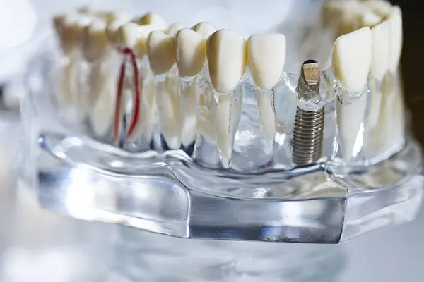 Dental Tooth Implant Titanium Prosthetic Dentists Model Shallow Dof — Stock Photo, Image