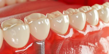 Diş implantını kapat. Diş implantı kavramının tıbben doğru üç boyutlu çizimi. 3B görüntüleme