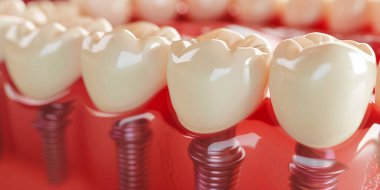 Diş implantını kapat. Diş implantı kavramının tıbben doğru üç boyutlu çizimi. 3B görüntüleme