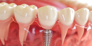 Diş implantını kapat. Diş implantı kavramının tıbben doğru üç boyutlu çizimi. 3B görüntüleme