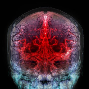 3 boyutlu, baştaki serebral arterin tıbben doğru çizimi.