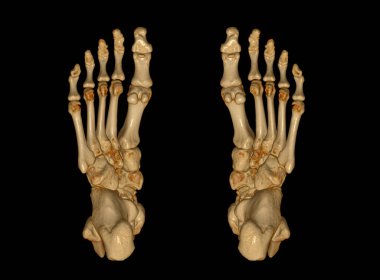 Tomografide kemik kırığı ve romatizma eklem iltihabı teşhisi için ayak kemiklerinin 3 boyutlu görüntülenmesi..