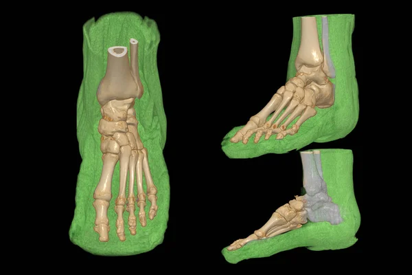 Rendering Foot Bones Diagnosis Bone Fracture Rheumatoid Arthritis Scannner — Stock Photo, Image