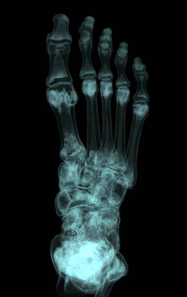 Weergave Van Voetbotten Voor Diagnose Botbreuk Reumatoïde Artritis Van Scanner — Stockfoto