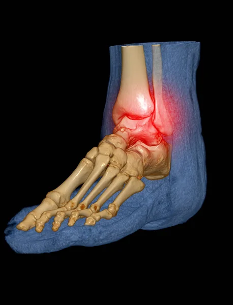 Renderelés Láb Csontok Diagnózis Csonttörés Reumás Ízületi Gyulladás Szkenner — Stock Fotó