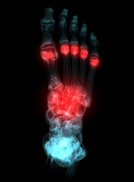 Weergave Van Voetbotten Voor Diagnose Botbreuk Reumatoïde Artritis Van Scanner — Stockfoto