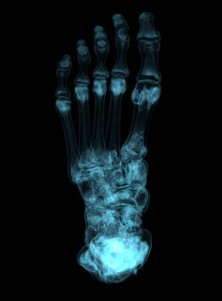 Renderowania Kości Stopy Diagnozy Złamania Kości Reumatoidalne Zapalenie Stawów Skanera — Zdjęcie stockowe