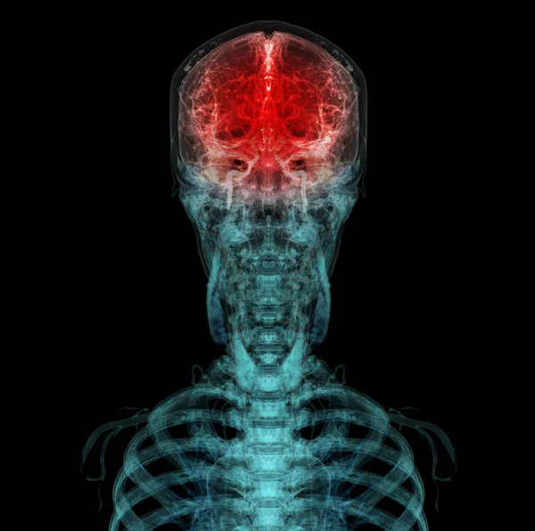 Renderowane Medycznie Dokładna Ilustracja Tętnicy Mózgowej Głowy — Zdjęcie stockowe