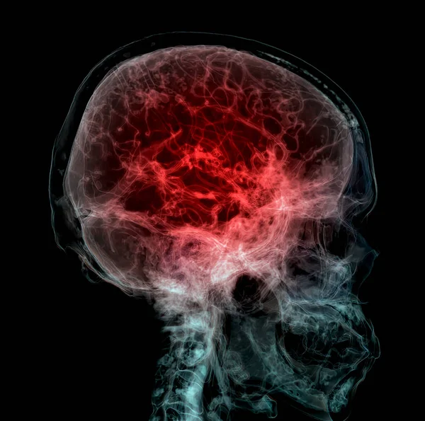 Тривимірна Медично Точна Ілюстрація Мозкової Артерії Голови — стокове фото