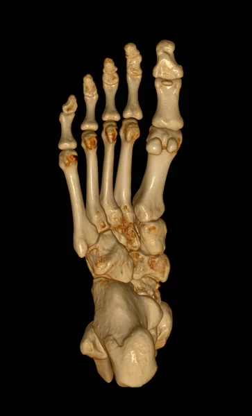 Renderowania Kości Stopy Diagnozy Złamania Kości Reumatoidalne Zapalenie Stawów Skanera — Zdjęcie stockowe