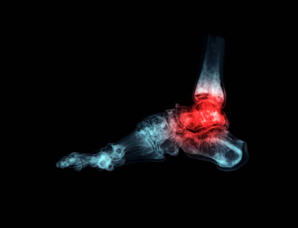 Rendering Der Fußknochen Zur Diagnose Von Knochenbruch Und Rheumatoider Arthritis — Stockfoto