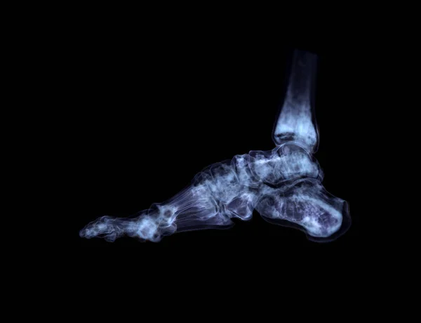 Репродукція Кісток Стопи Діагностики Переломів Кісток Ревматоїдного Артриту Від Сканера — стокове фото