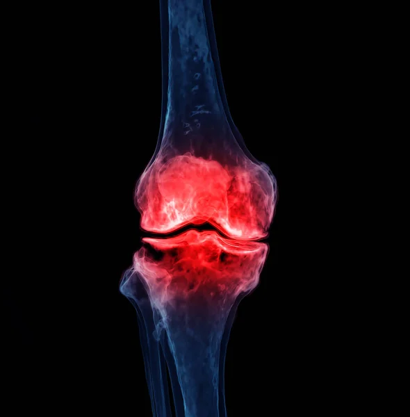 黑色背景下孤立膝关节的3D再环显示痛处 — 图库照片