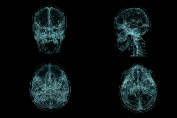 Collectie Van Menselijke Schedel Hersenen Door Scan Ray Visualisatie Binnenkant — Stockfoto