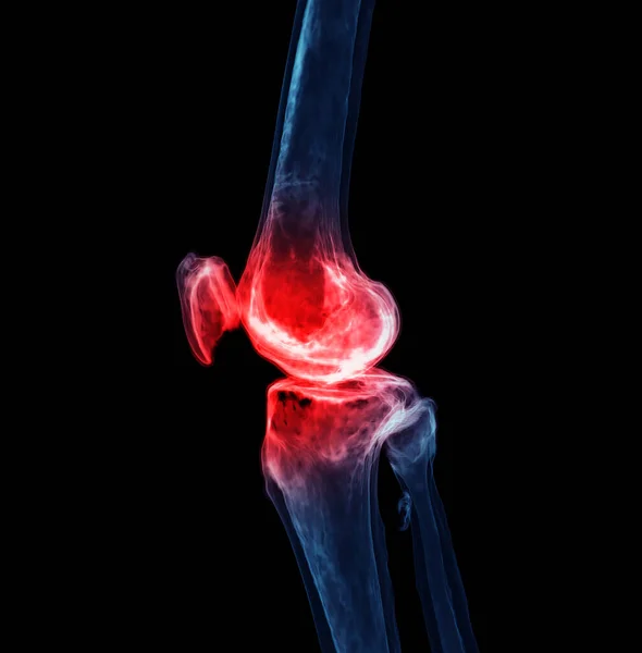 黑色背景下孤立膝关节的3D再环显示痛处 — 图库照片