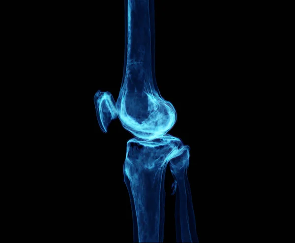 Renderering Van Het Kniegewricht Geïsoleerd Zwarte Achtergrond Toont Pijn Gebied — Stockfoto