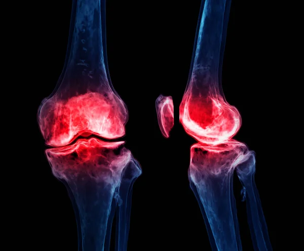 膝関節の黒の背景に隔離された3Dレンダリング痛み領域を示す — ストック写真