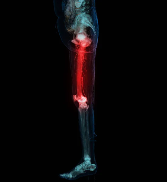 Der Unteren Extremität Darstellung Des Femurknochens Des Kniegelenks Des Beines — Stockfoto