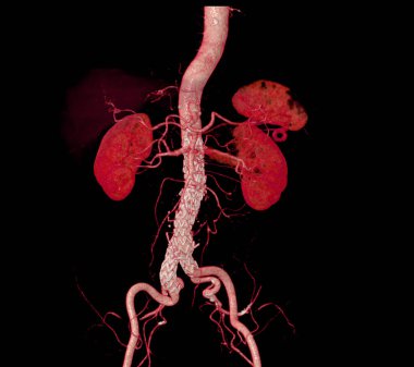 Abdominal aort grefti olan CTA tüm aortu abdominal aort anevrizması durumunda 3D oluşturma görüntüsünü karşılaştır.