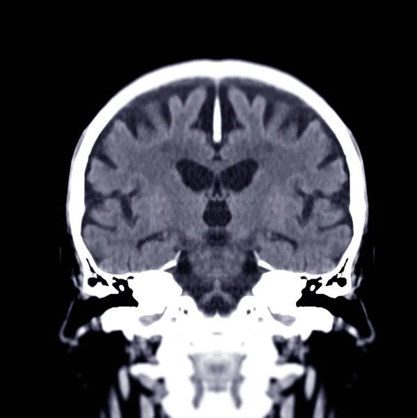 Scan Van Hersenen Coronale Weergave Voor Diagnose Hersentumor Beroerte Ziekten — Stockfoto