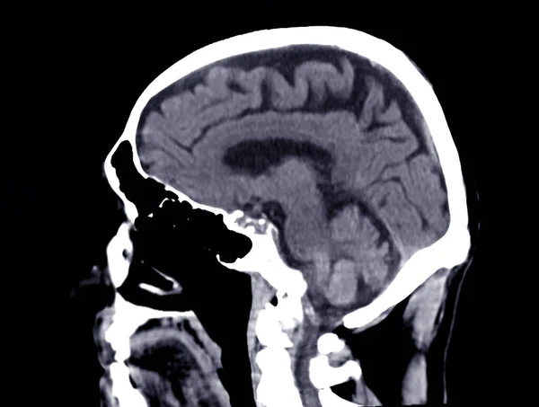 Scan Van Hersenen Sagittale Weergave Voor Diagnose Hersentumor Beroerte Ziekten — Stockfoto