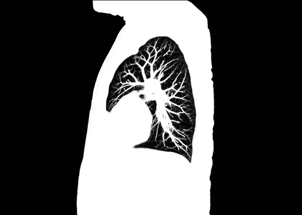 Sken Hrudníku Nebo Plicní Sagitální Pohled Radiologickém Oddělení Nemocnici Covid — Stock fotografie