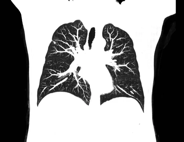 病院の放射線科で胸部または肺冠動脈ビューのCtスキャン Covid 19スキャンボディX線検査 Covidウイルスの流行拡散コンセプト — ストック写真