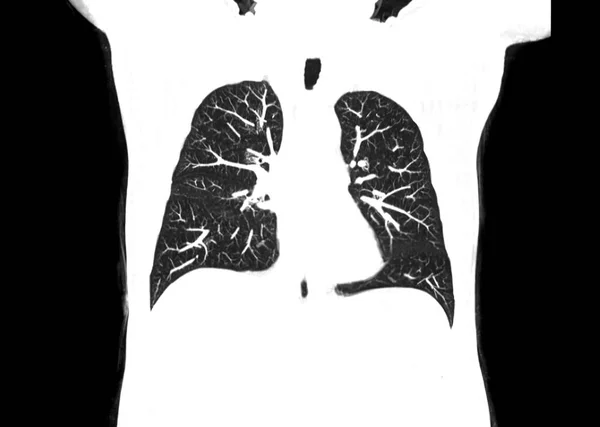 Αξονική Τομογραφία Στήθους Πνευμόνων Στο Ακτινολογικό Τμήμα Του Νοσοκομείου Ανίχνευση — Φωτογραφία Αρχείου
