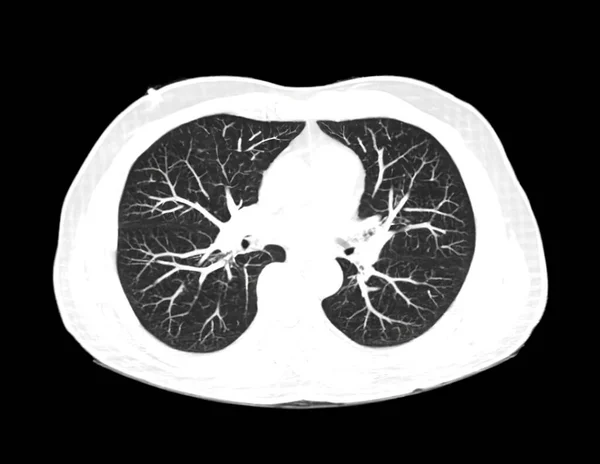 Aufnahme Der Brust Oder Der Lunge Der Radiologischen Abteilung Des — Stockfoto