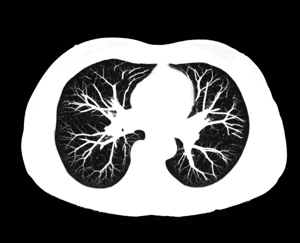 Sken Hrudníku Nebo Plicní Axiální Pohled Radiologickém Oddělení Nemocnici Covid — Stock fotografie