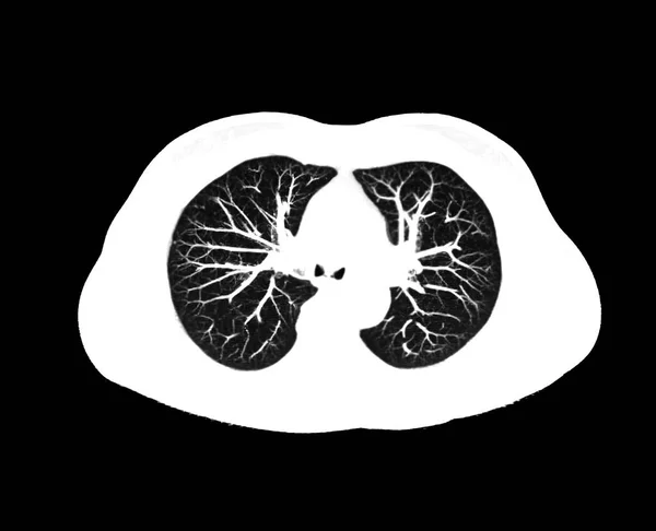Tac Della Vista Assiale Toracica Polmonare Reparto Radiologia Dell Ospedale — Foto Stock