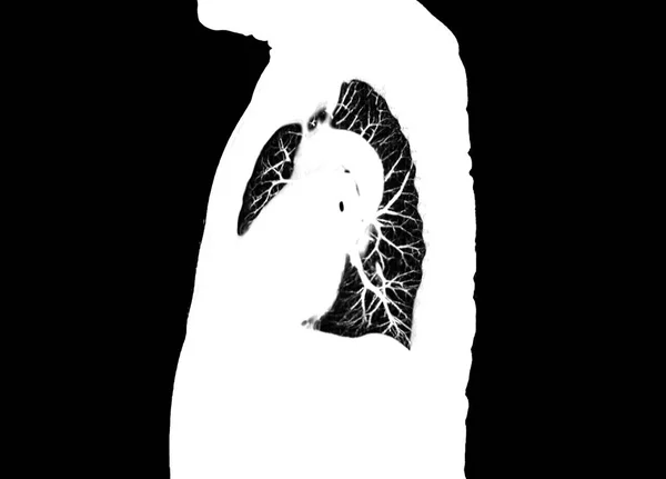 Hastanedeki Radyoloji Bölümünde Göğüs Tomografisi Akciğer Sagital Görüntüsü Covid Vücut — Stok fotoğraf