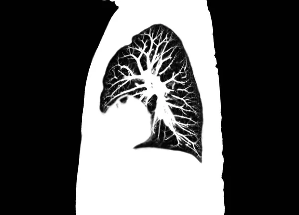 Mellkas Vagy Tüdő Sagittális Képének Radiológiai Osztályon Kórházban Covid Scan — Stock Fotó