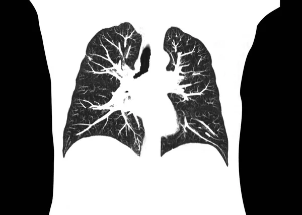 Datortomografi Bröstkorgen Eller Lungkoronalen Röntgenavdelningen Sjukhuset Covid Scan Body Xray — Stockfoto