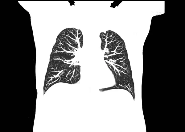 Tomografia Klatki Piersiowej Lub Płuc Oddziale Radiologii Szpitalu Badanie Prześwietlenia — Zdjęcie stockowe