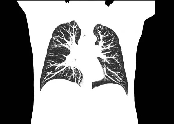 Sken Hrudníku Nebo Plicní Koronární Pohled Radiologickém Oddělení Nemocnici Covid — Stock fotografie