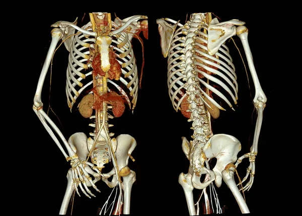 Cta Celá Aorta Brachiální Tepna Vykreslování Obrazu Případě Pacienta — Stock fotografie