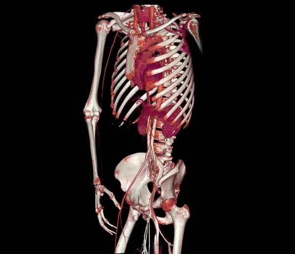 Cta Celá Aorta Brachiální Tepna Vykreslování Obrazu Případě Pacienta — Stock fotografie