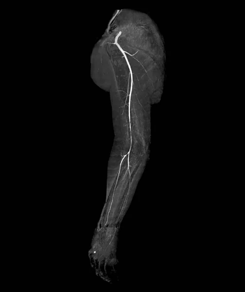 Cta Artéria Braquial Tomografia Computadorizada Extremidade Superior Imagem Renderização — Fotografia de Stock