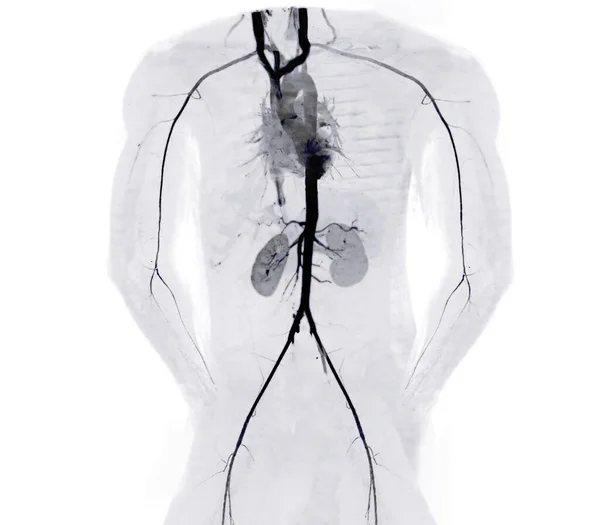Cta Aorta Entera Arteria Braquial Imagen Renderizado Caso Paciente Tramático — Foto de Stock